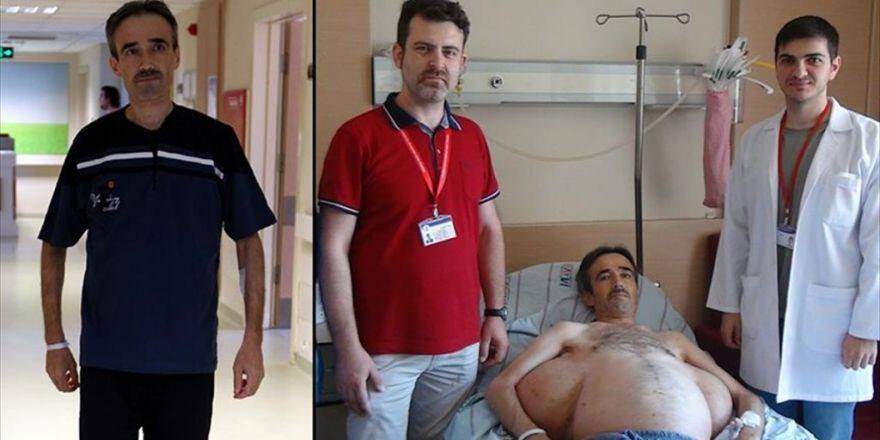 Sırtındaki 25 Kiloluk 'Yük'ten 30 Yıl Sonra Kurtuldu