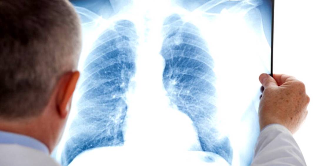 Sigara içenler KOAH’tan kurtulabilecek mi? İşte KOAH’tan kurtulmanın en kolay yolu 8