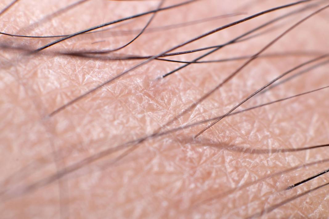 Tüyler neden diken diken olur? İşte tıbbi açıklaması 5