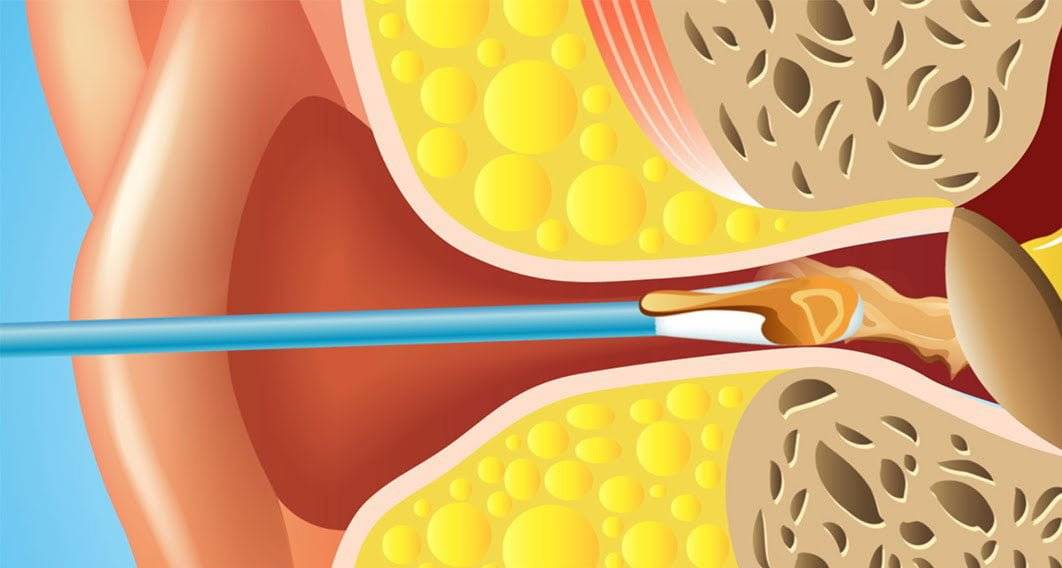 Kulağınızı böyle temizlemeyin! Uzmanlardan kritik uyarı 5