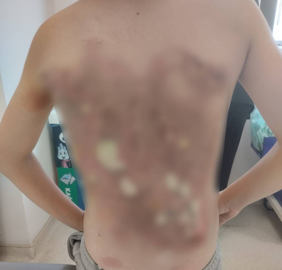 12 yaşındaki çocuğu ateşe verdiler! 1