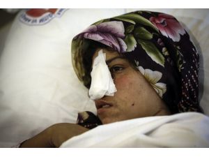Burnu kesilen Afgan kadın Ankara'da tedavi altına alındı