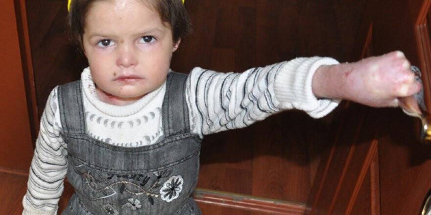 Suriyeli minik kız Konya'da  şifa bekliyor