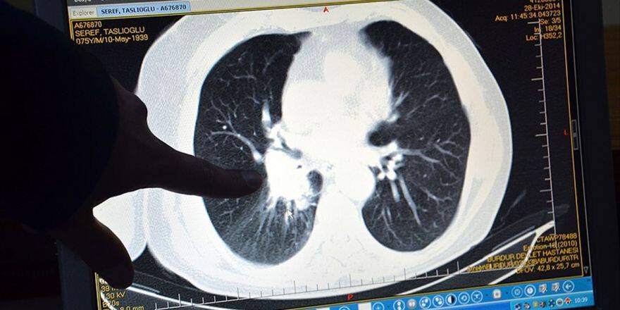 Sü Tıp Fakültesi Dekanı Prof. Dr. Göktaş: Türkiye'de Erkeklerde En Sık Akciğer Kanseri Görülüyor
