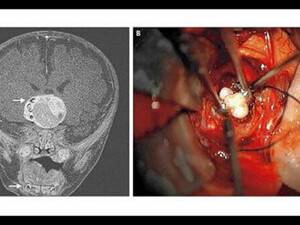 Bebeğin Beyninden Öyle Bir Şey Çıktı Ki!