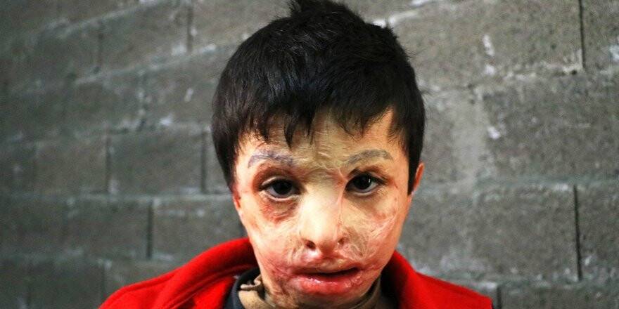 Esad’ın varil bombası 7 yaşındaki Mahmud’u yaktı
