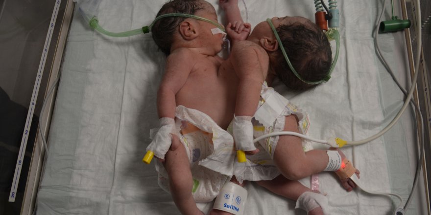 Konya’da doğan yapışık ikizler Selçuk Tıp’ta ayrıldı