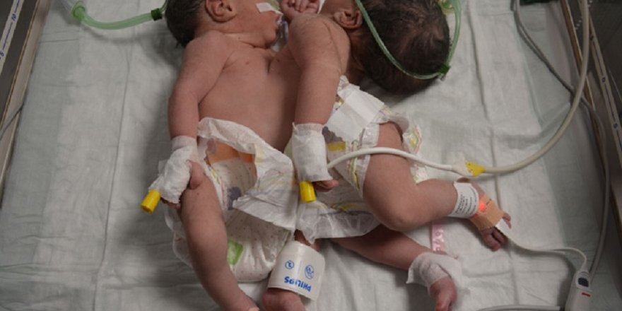 Ameliyatla Ayrılan Suriyeli Siyam İkizlerinden Biri Hayatını Kaybetti