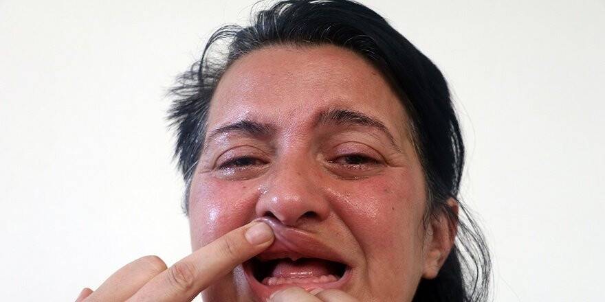 'Bembeyaz dişlerim olsun' istedi, 32 dişinden oldu