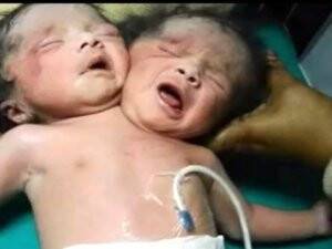 Hindistan'da İki Kafalı Bebek Dünyaya Geldi