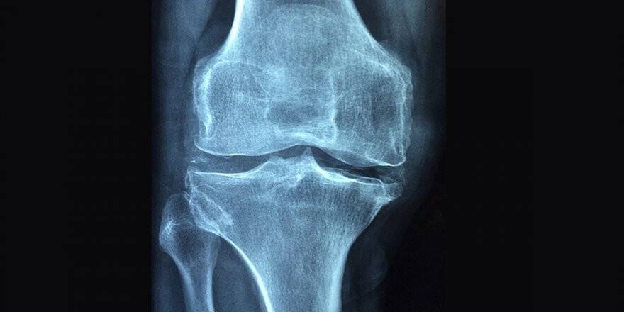 'Osteoporoz 3 Kadından Birini Kıskacına Alıyor'