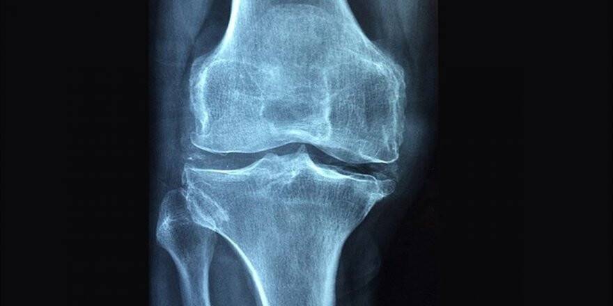 Romatizmal Hastalıklar 'Osteoporoz' Riskini Artırıyor