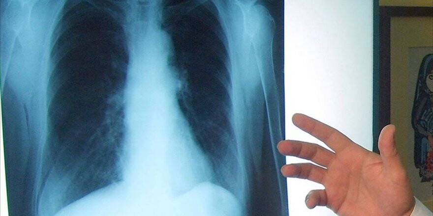 Akciğer Kanserinde Yeni Tedavi Yöntemleri Sağ Kalım Süresini Artırıyor