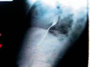 Sarhoşken İddiaya Girip Çatal Yuttu