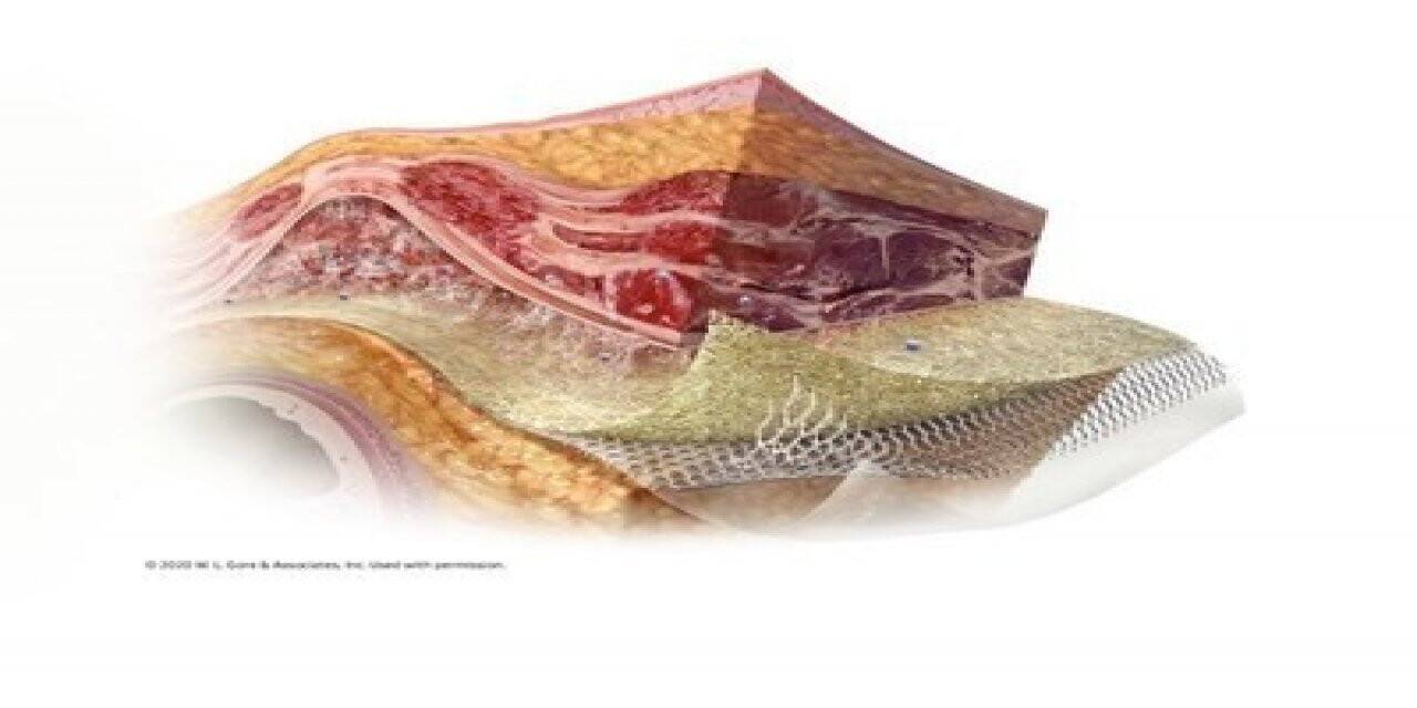 Gore Synecor Intraperitoneal biyomateryali piyasaya sürdü