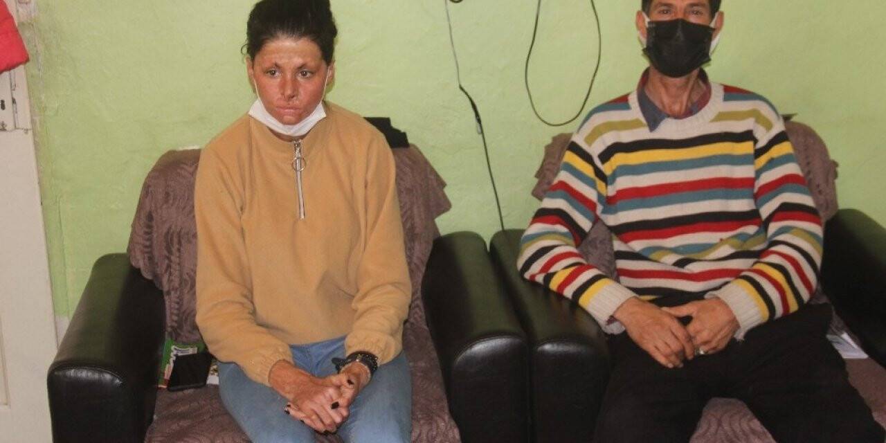 Bitlenen saçlarını benzinle yıkamak isterken kendini yakan kız yardım eli bekliyor