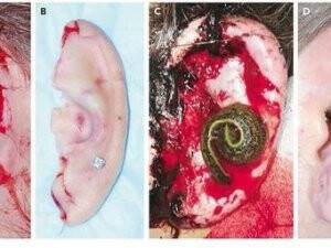 Kopan Kulağa Sülük İle Tedavi