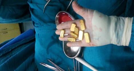 Hint Adamın Karnından Servet Çıktı