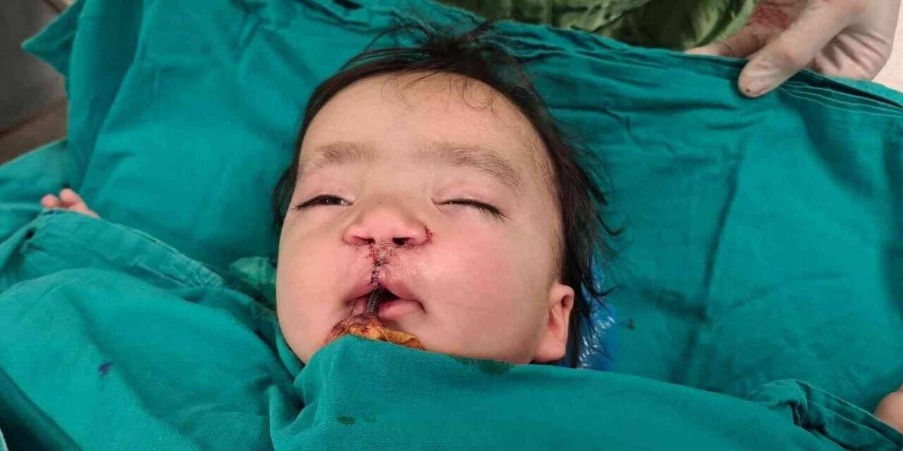 Yarık damak ve dudaklı bebeğe "Türk lalesi" ameliyatı