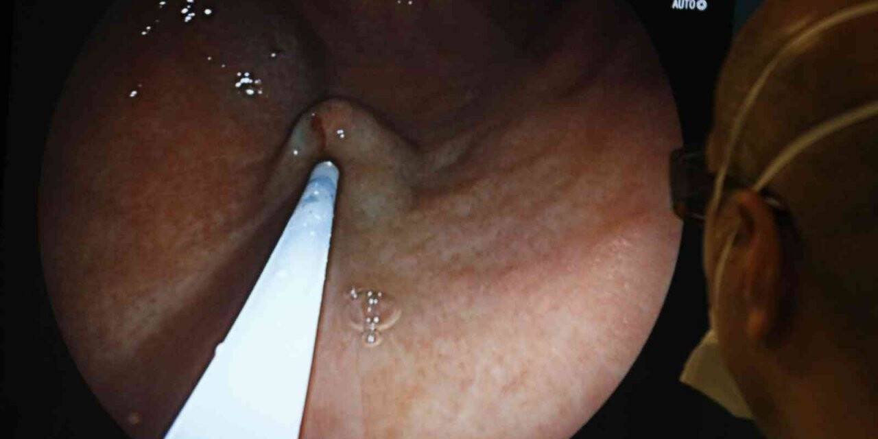 Mide botoksunda 15 dakikalık işlemle hastalar rutin yaşamlarına devam ediyor