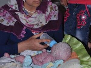 Nadir görülen deri hastalığıyla dünyaya gelen bebek
