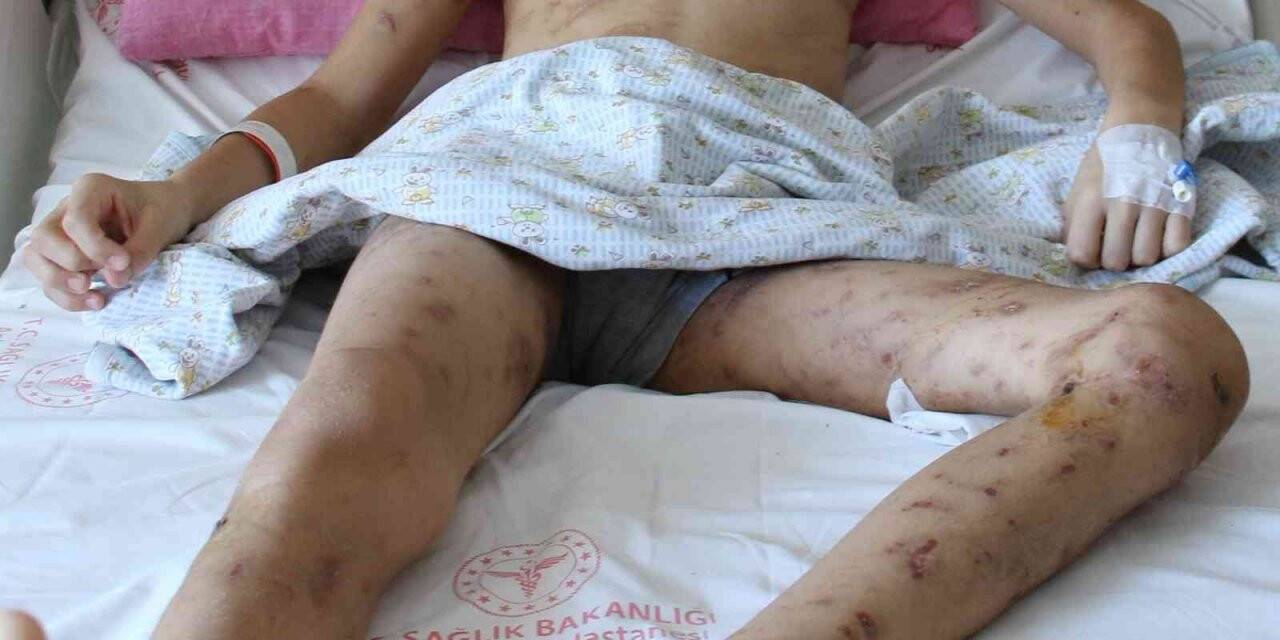 10 köpeğin saldırısına uğrayan 12 yaşındaki Enes, 9 cerrahi operasyon geçirdi, 6-7 tane daha geçirmesi planlanıyor