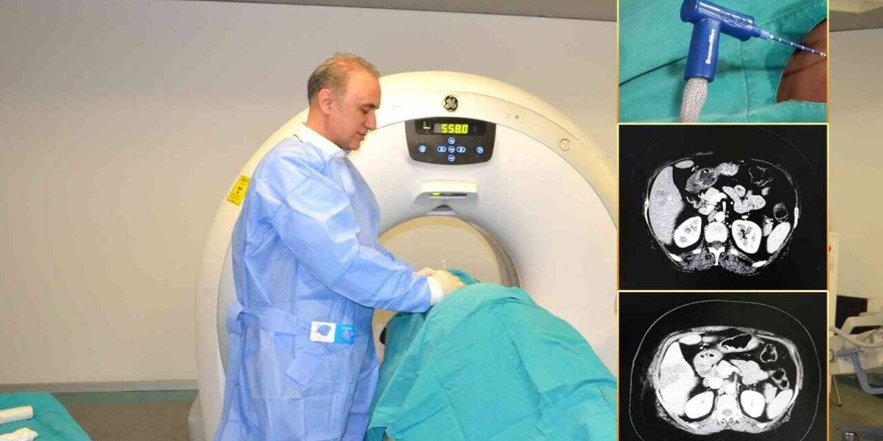 Karaciğer kanseri tedavisinde ‘Mikrodalga Ablasyon’ yöntemi