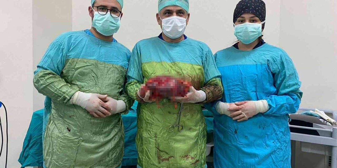 Karnında şişlik olan hastanın büyüyerek 25 santim olan böbreği alındı