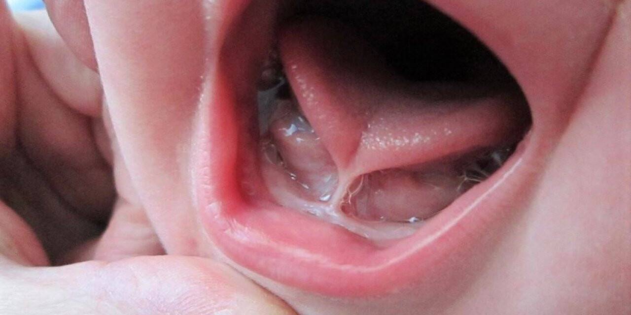 “Dil bağı bebeklerde ciddi gelişim sorunlarına yol açabiliyor”