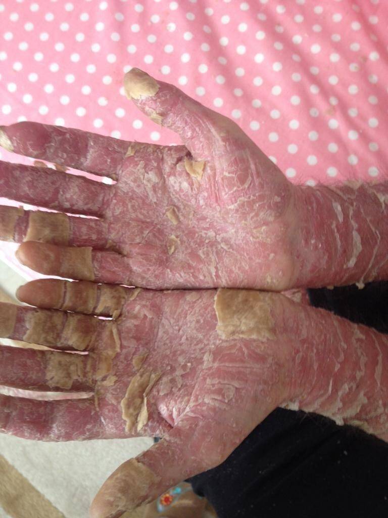 Sedef hastalarından kaçmayın, bulaşıcı değil