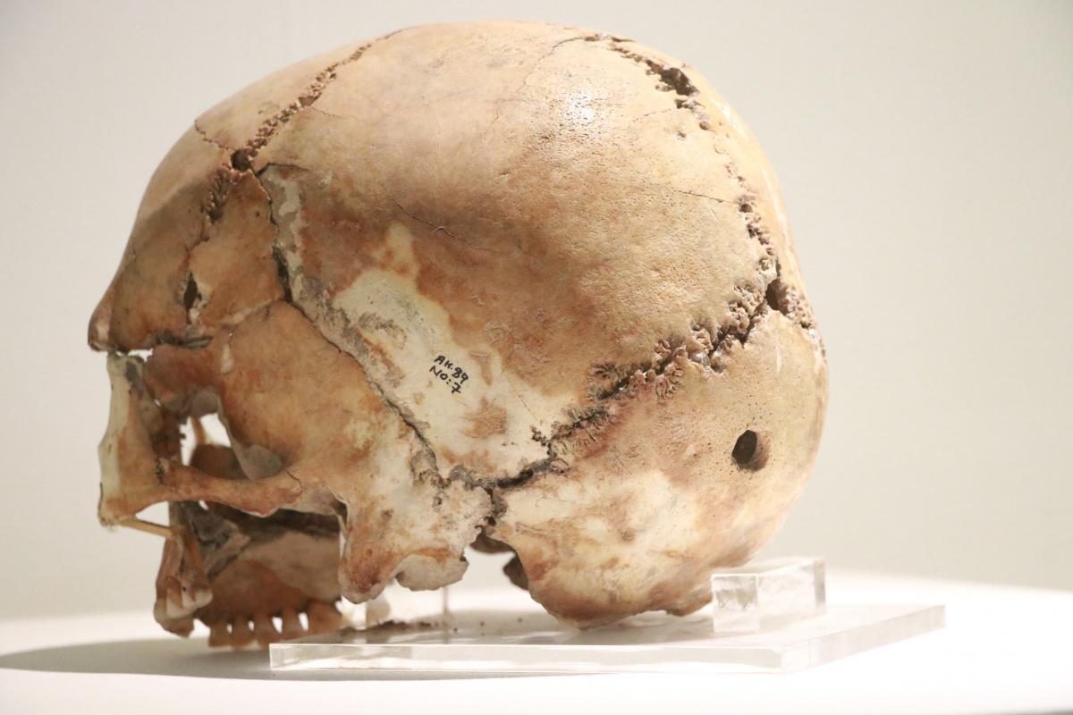 Dünyanın ilk beyin ameliyatı 10 bin 500 yıl önce Aksaray'da yapıldı