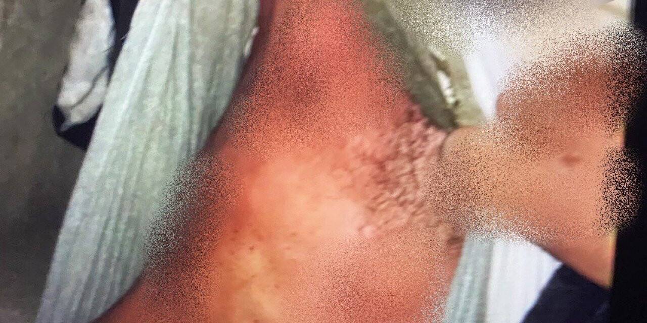 Hırsızlık için girdiği elektrik trafosunda akıma kapılan şahıs ağır yaralandı