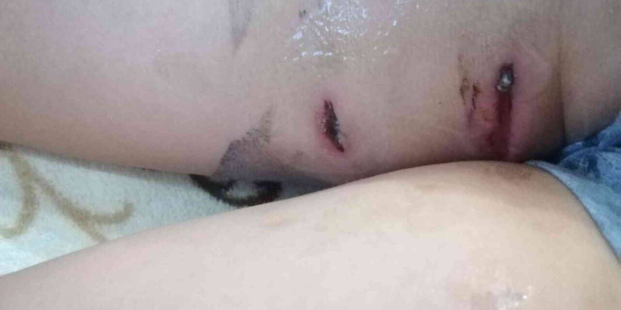 Başıboş köpeklerin saldırısından ölü taklidi yaparak kurtuldu