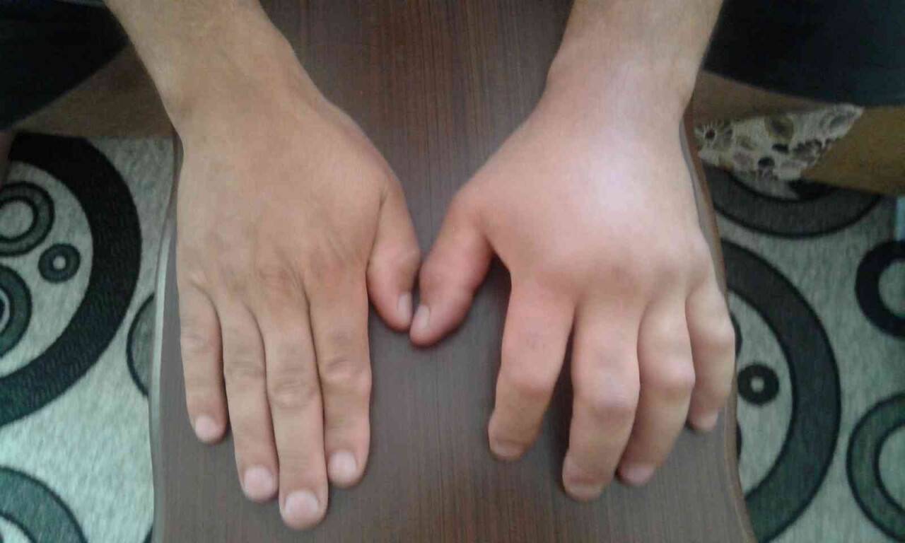 Türkiye’de tanınmayan hastalık: Alerji mi Herediter Anjiyoödem mi