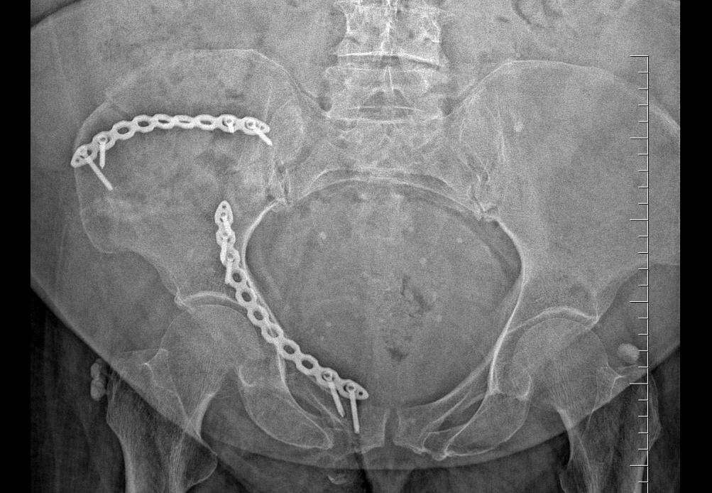 Kırılan leğen kemiğini 20 halkalık zincirle birleştirdiler