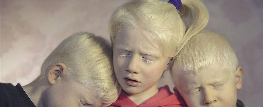 Albinizmli bireyler, dünya genelinde insan hakları ihlallerine maruz kalıyor