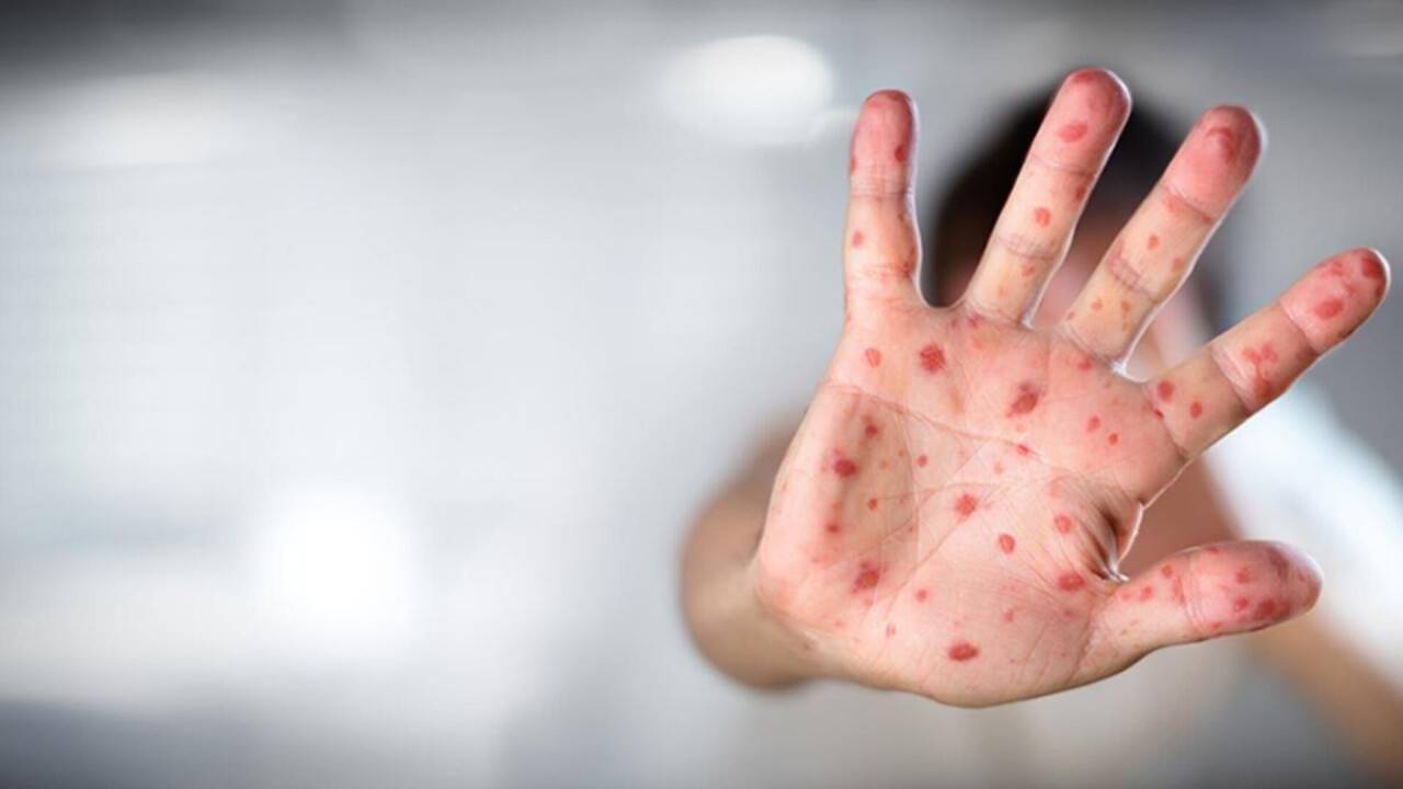 Uzmanından maymun çiçeği açıklaması: “Covid’deki gibi evlere kapanmayı beklemiyoruz”