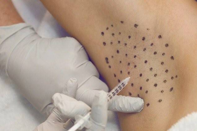 Sosyal yaşantıyı ve öz güveni negatif etkileyen aşırı terleme botoks ile tedavi edilebiliyor