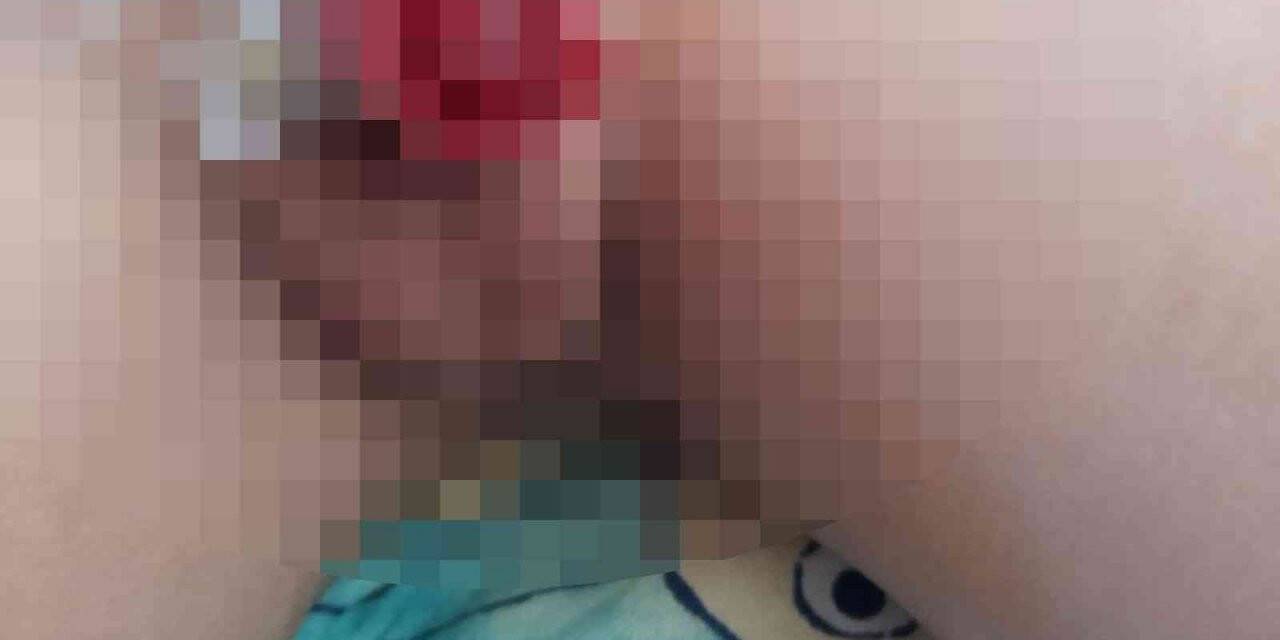 Yanlış sünnet edilen çocuğun hayatı karardı: “21 gündür su içmeye korkuyor”