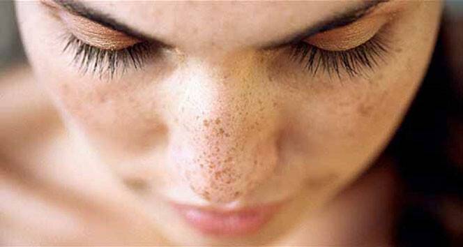 Yaz mevsiminde en çok görülen cilt hastalıkları