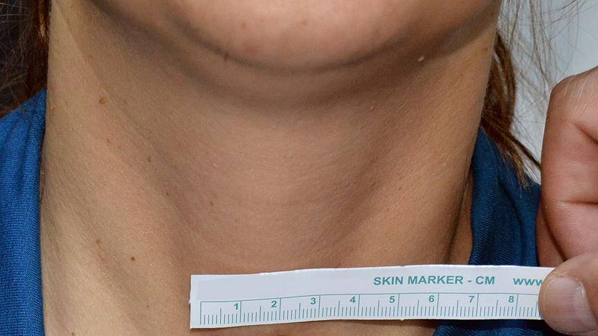 Boynunuzda elinize gelen şişliği önemseyin