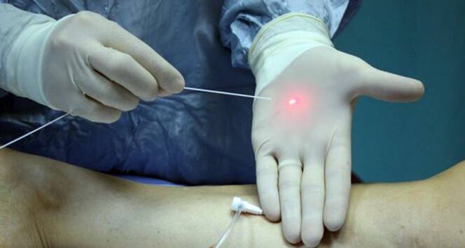 Yapıştırıcı ile yeni nesil varis tedavisi