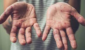 Maymun çiçeği virüsü 92 ülkede görüldü: Dünya genelindeki vaka sayısı 35 bini aştı