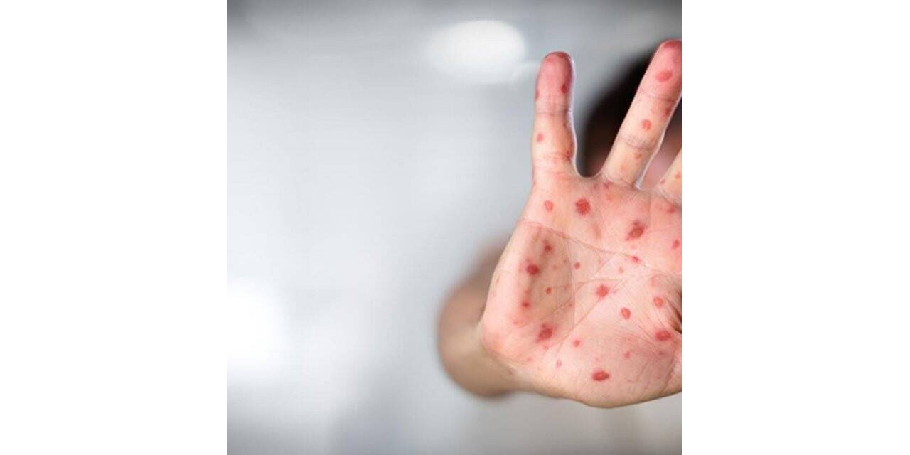 Fransa’da insandan köpeğe maymun çiçeği virüsü bulaştı