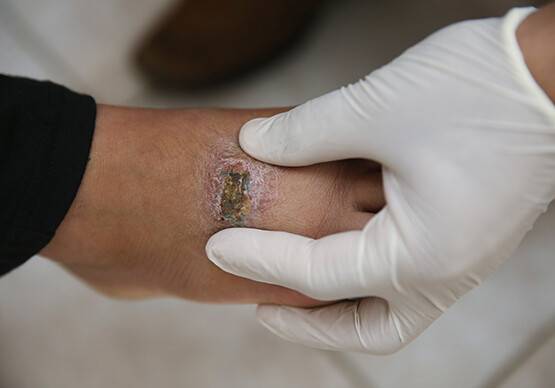 Çıban enfeksiyonu ölümcül olabilir