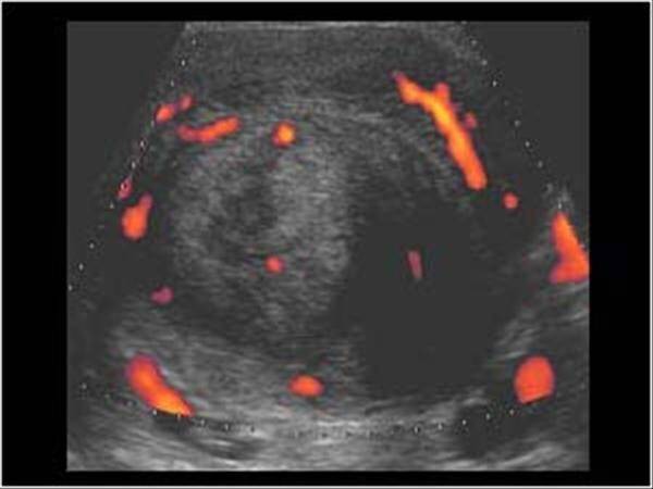 Karındaki şişlik kilo değil miyom olabilir