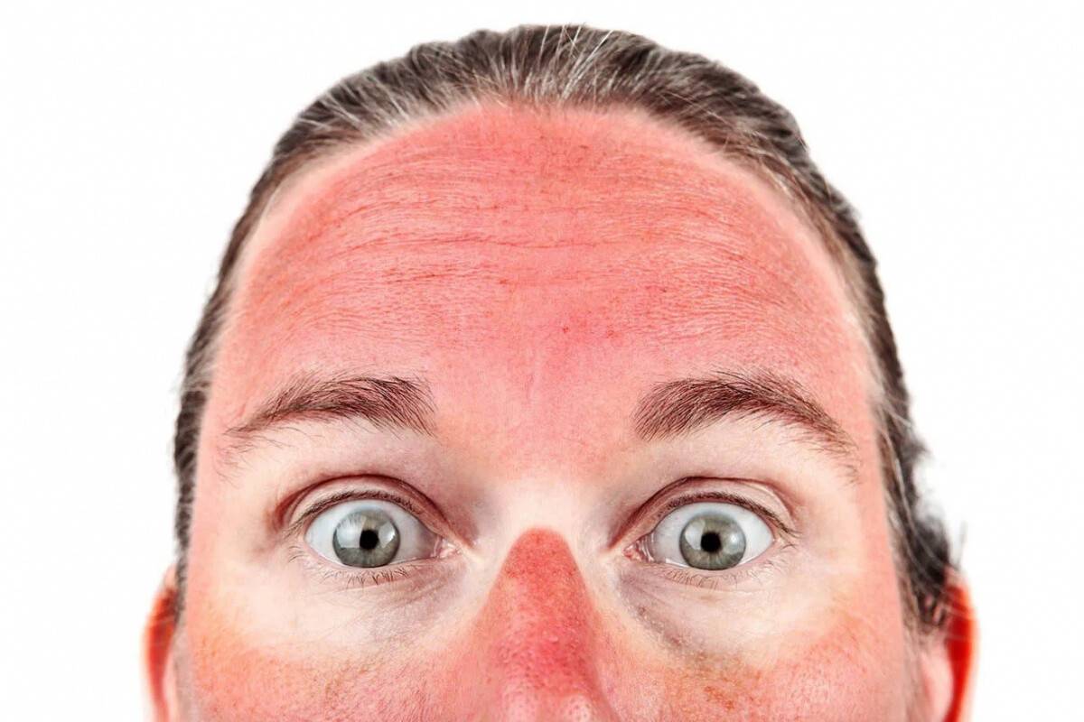 Güneşlenirken dikkat edin; yaşlanmayı hızlandırıyor