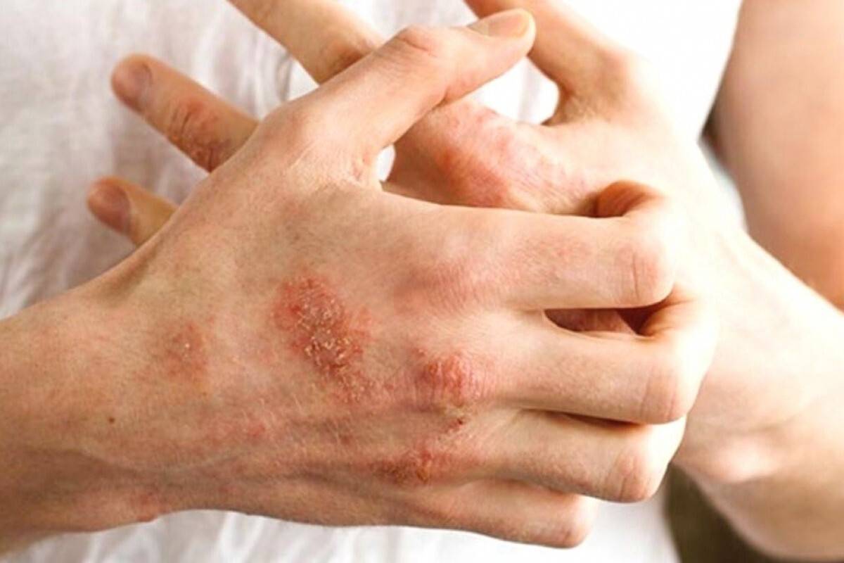 Egzaması olan çocuklarda besin alerjisine dikkat