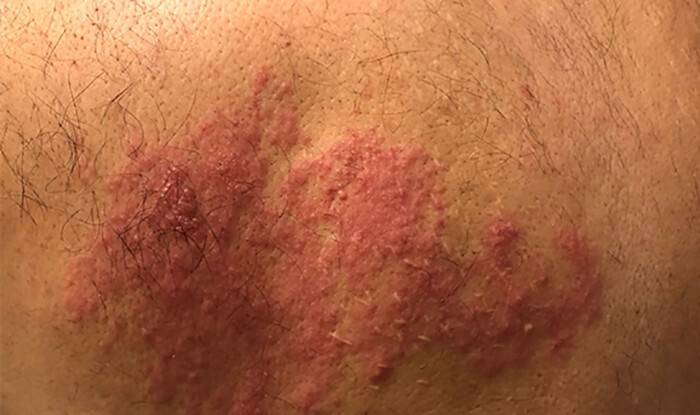 Zayıflayan bağışıklık zona vakalarını artırdı