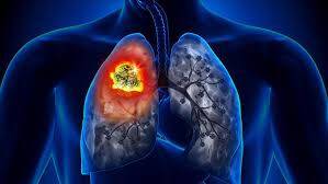 Uzmanından korkutan Akciğer kanseri uyarısı